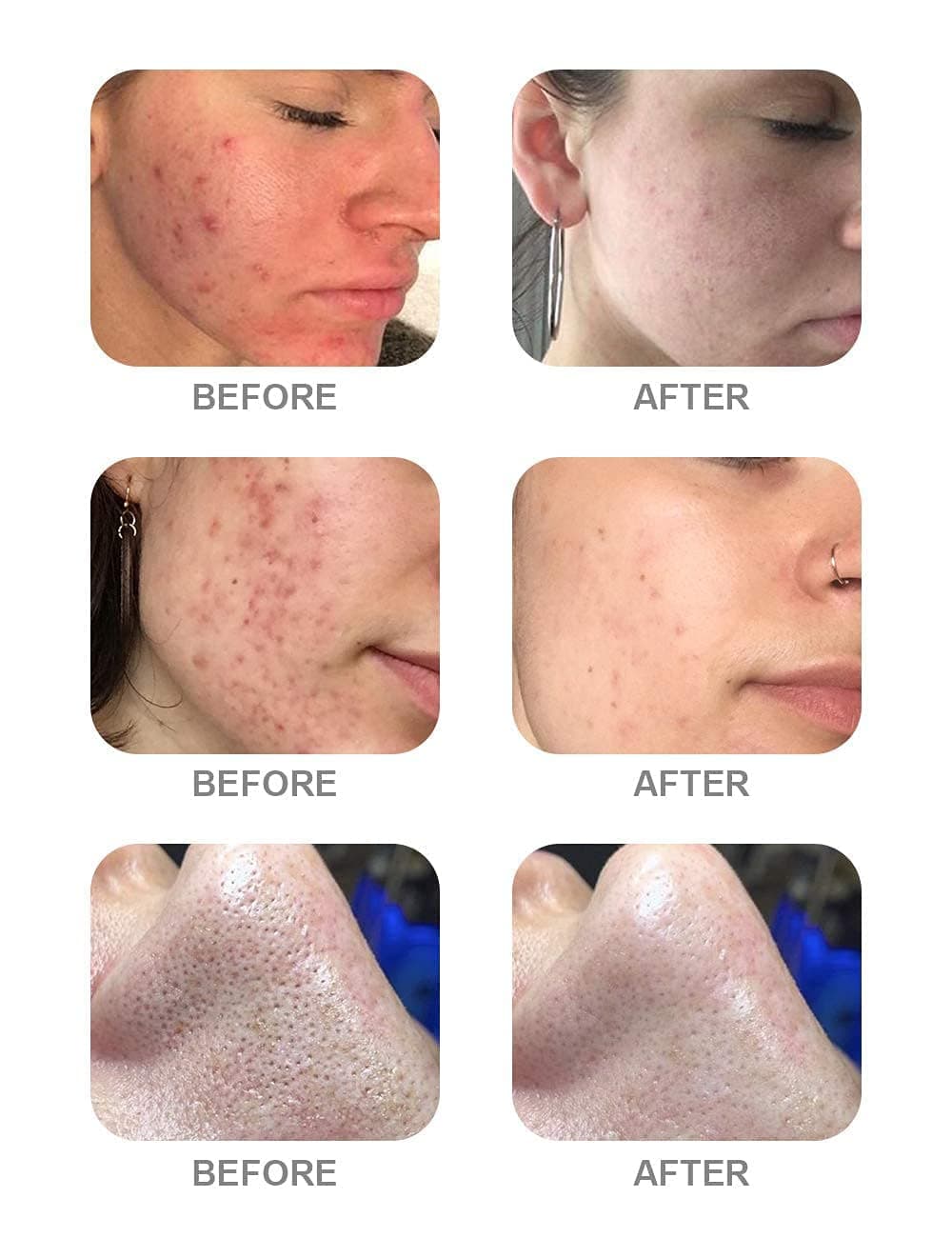 BELLA FACCIA Hydra Facial Machine Solution Hydra Facial Aqua Peeling Solution AHA BHA Hydrafacial Serum 1500ml